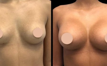 Where to Find the Best Breast Augmentation Surgeon in Dubai