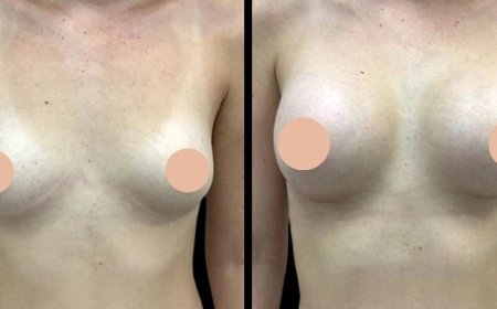 What to Expect During Your Breast Augmentation Surgery with the Best Doctors in Dubai