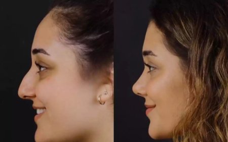 How Septoplasty in Dubai Differs from Rhinoplasty