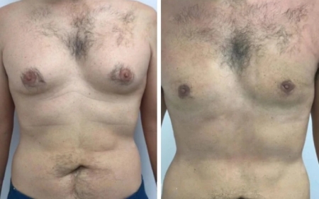 How Gynecomastia Surgery in Dubai Helps Improve Posture and Body Shape