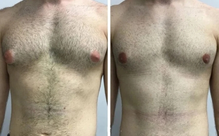 Gynecomastia in Dubai: Real Patient Stories and Testimonials