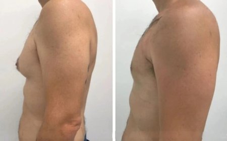 Is Gynecomastia in Dubai the Best Option for You?