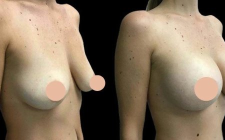 Legal and Ethical Aspects of Breast Augmentation Surgery in Dubai