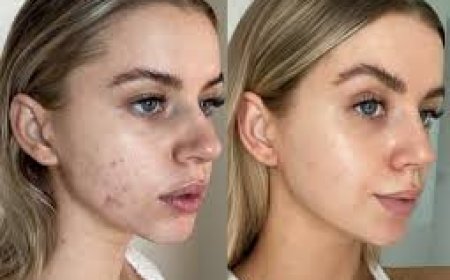 PRP treatment for face PRP for Skin Tightening and Lifting Without Surgery