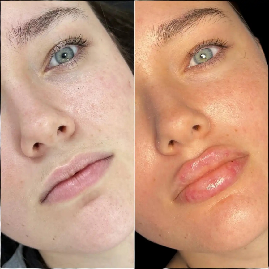 Best Doctors in Dubai for Fillers: Safe and Stunning Enhancements