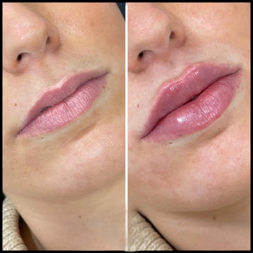 The Best Doctors in Dubai on Using Russian Lip Fillers for Lip Hydration