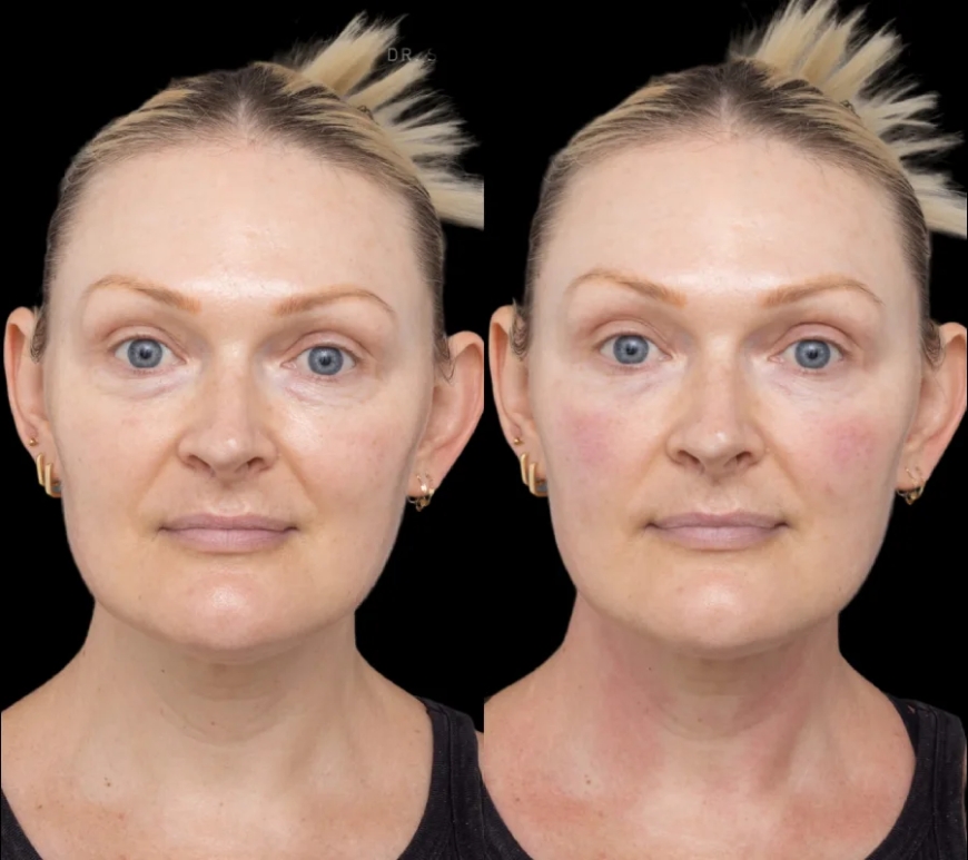 Why Under Eye Fillers by the Best Doctors in Dubai Are Safe and Reliable