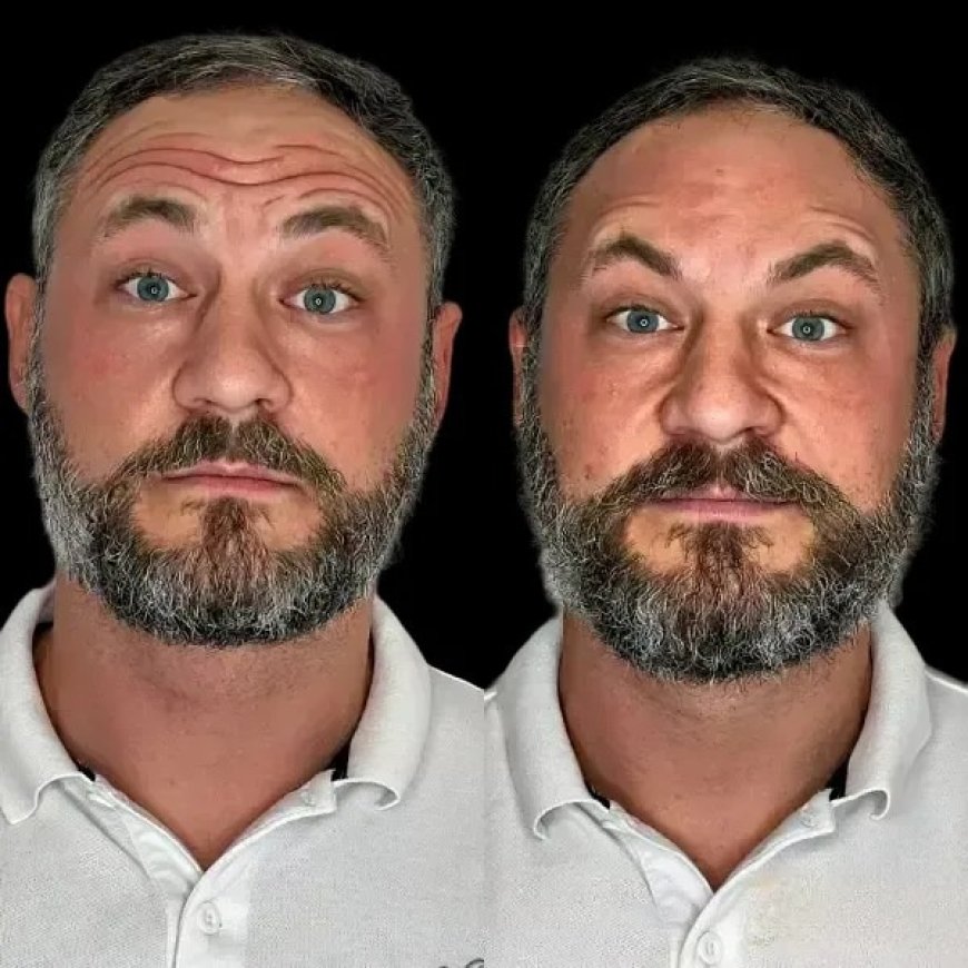 Sculpt Skin Freshness with Profhilo in Best Aesthetic Clinic in dubai