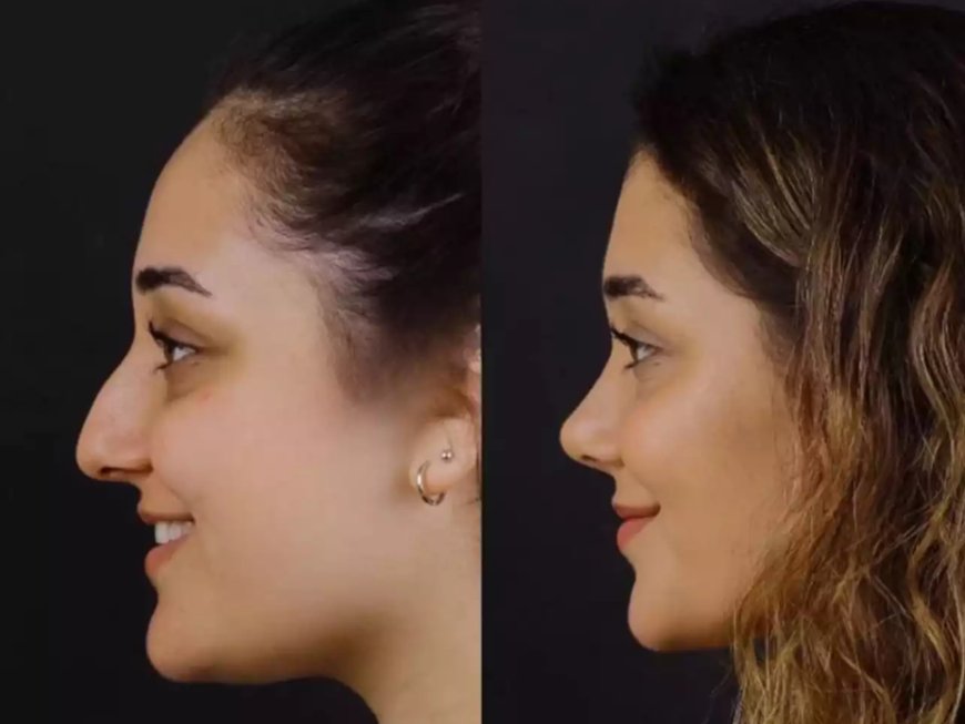 How Septoplasty in Dubai Differs from Rhinoplasty