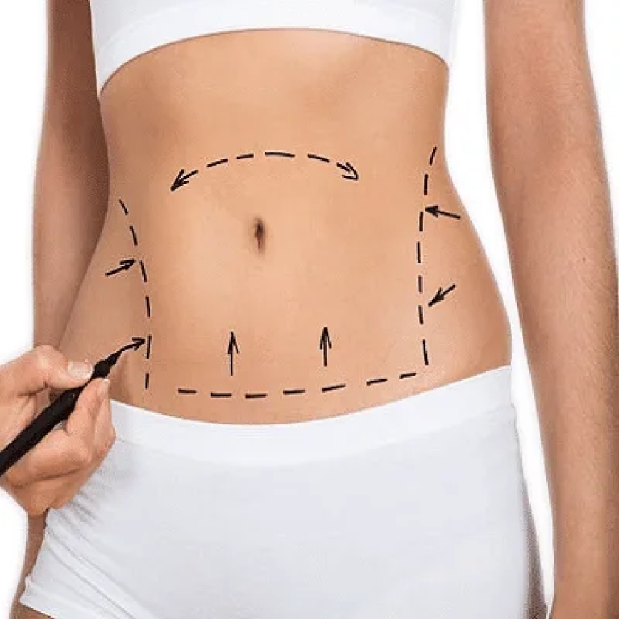 Fat Transfer in Dubai: The Procedure, Recovery, and Results You Can Expect