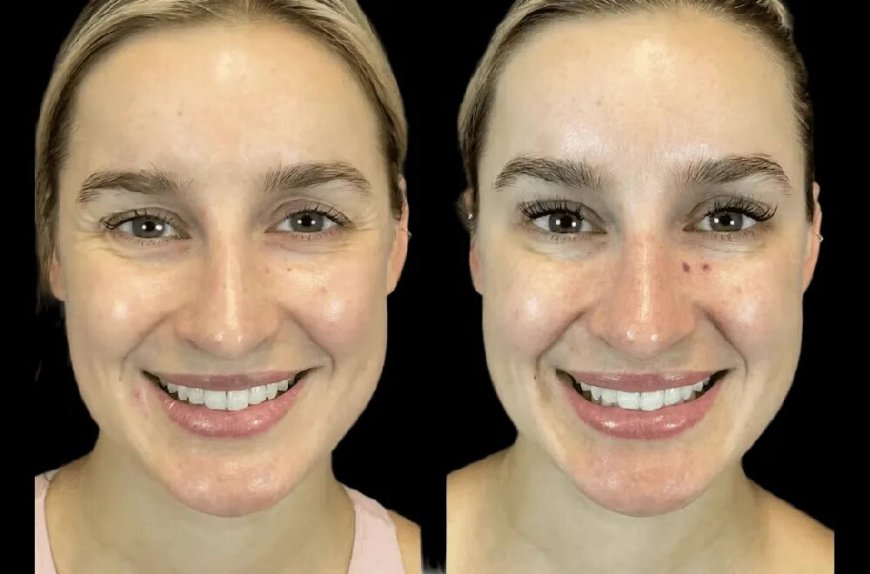 Latest Botox Injection Techniques Used at the Best Aesthetic Clinics in dubai