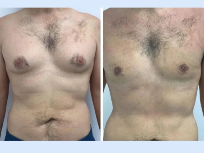 How Gynecomastia in Dubai Surgery Helps Improve Posture