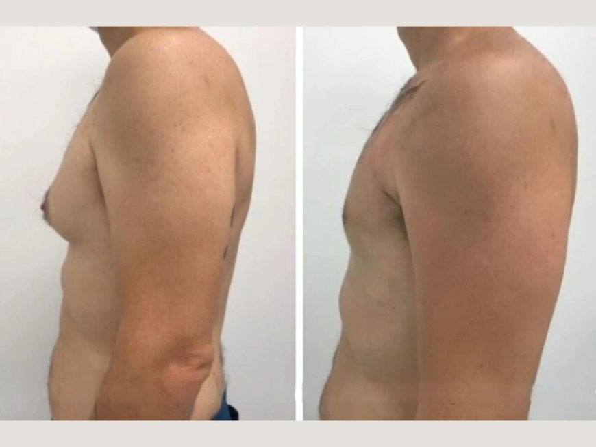 Is Gynecomastia in Dubai the Best Option for You?