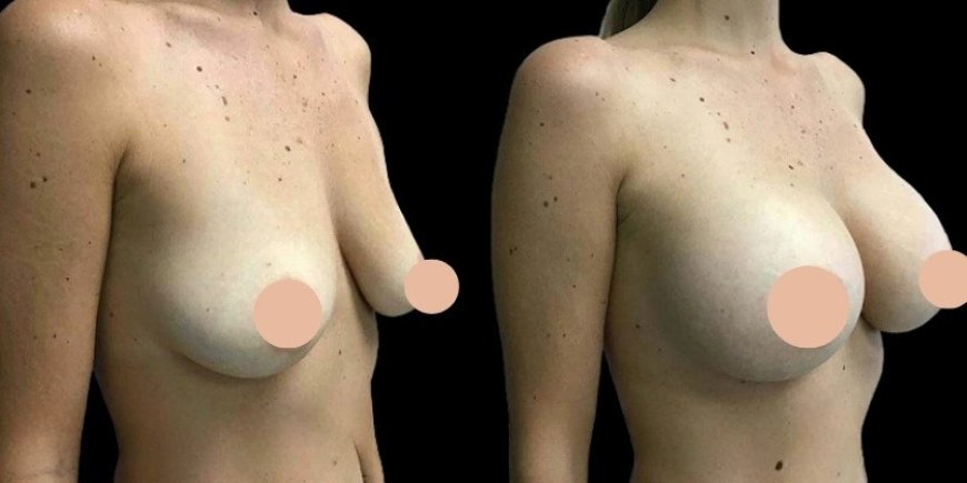 Legal and Ethical Aspects of Breast Augmentation Surgery in Dubai