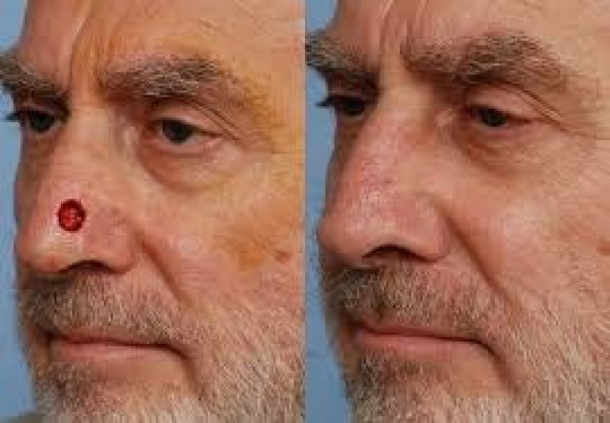 Finding Expert Mohs Surgeons Near You: A Guide to Skin Cancer Treatment