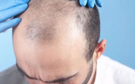 Hair Transplants on a Budget: What You Need to Know