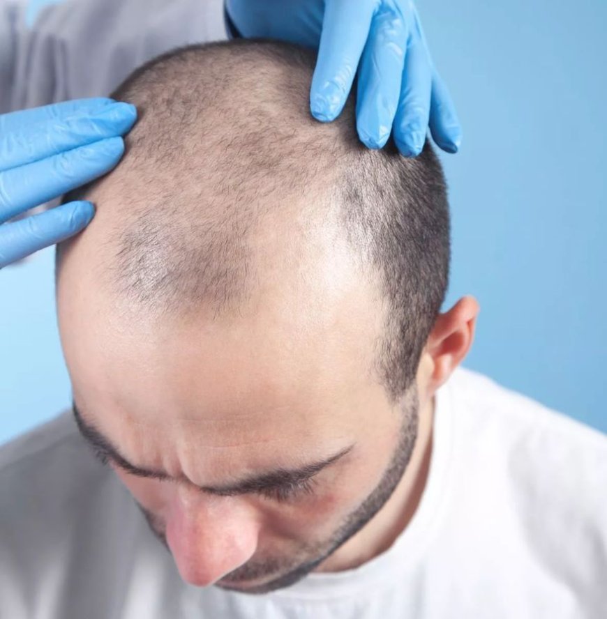 Hair Transplants on a Budget: What You Need to Know