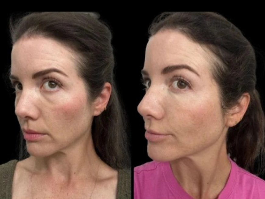 How Dark Circles Treatment in Dubai Can Help You Look Refreshed and Youthful