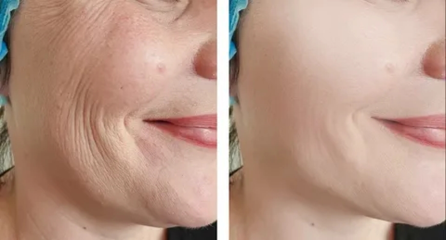 Gesichtsfalten entfernen: Die effektivsten Behandlungen im Überblick