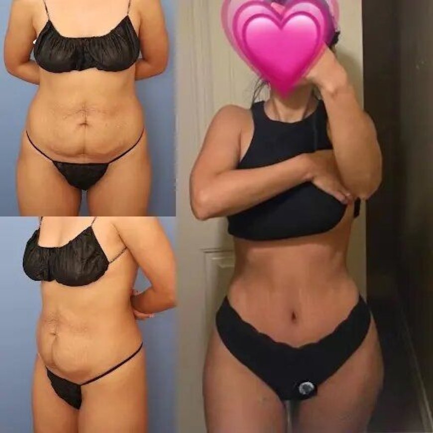 Tummy Tuck in Dubai: Trusted Doctors and Patient Support